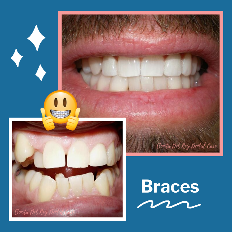 Braces-Before-After